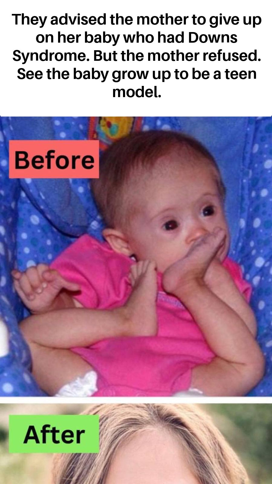 They advised the mother to give up her Down syndrome kid, but she refused to do so… Here is how she looks today as a model!