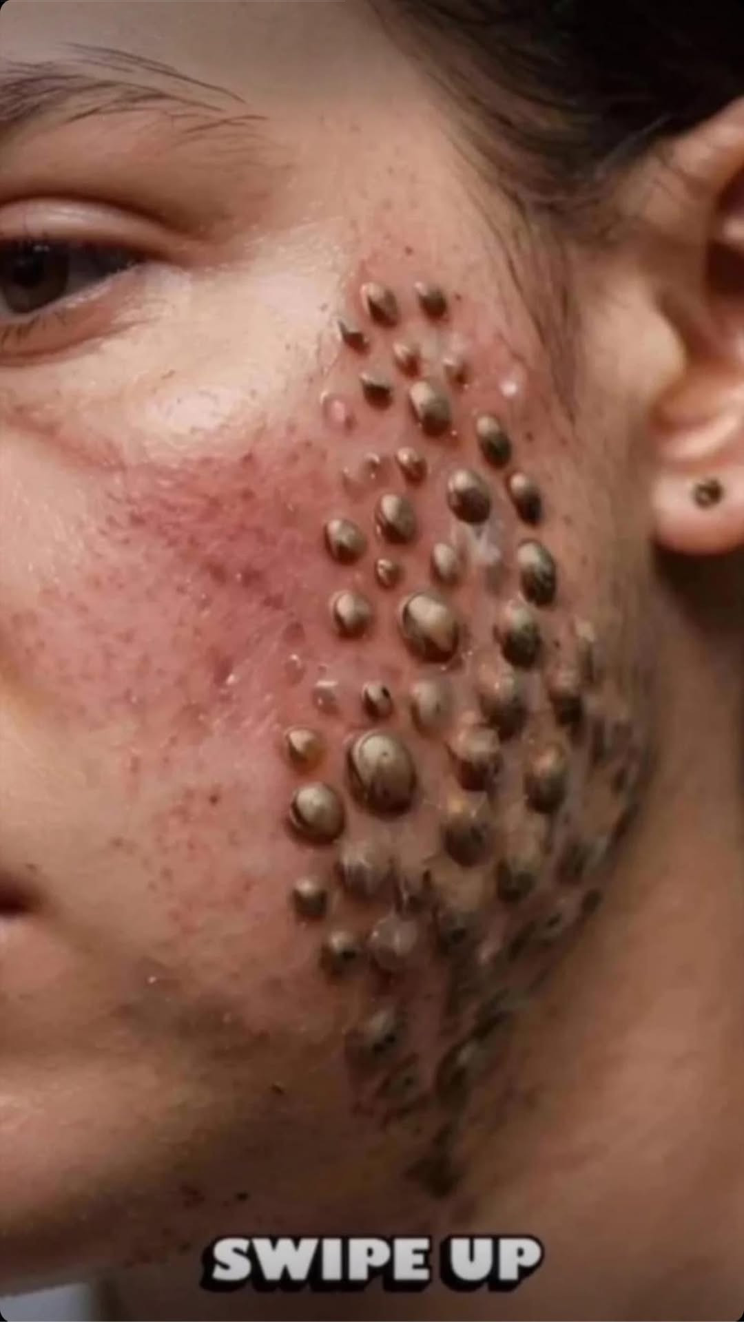 What the Acne on 8 Body Parts Is Trying to Tell You About Your Lifestyle Habits