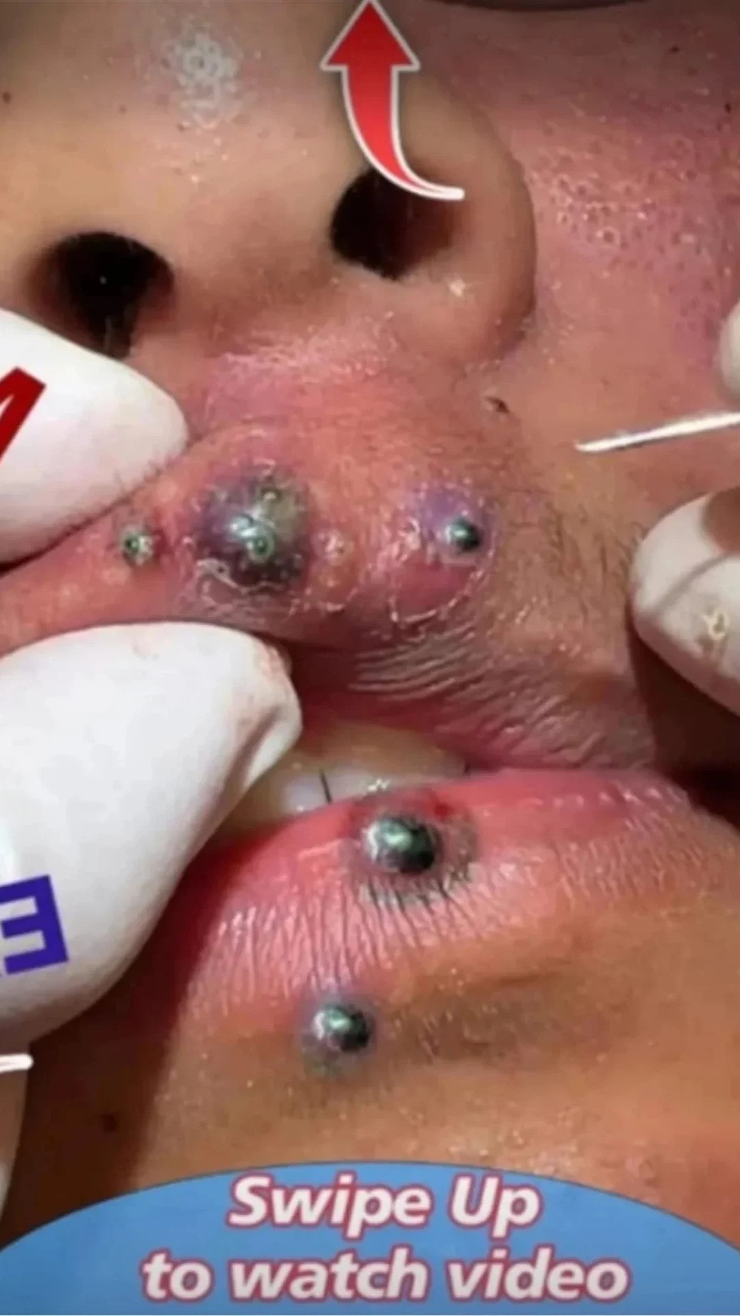 SKIN blackhead treatment