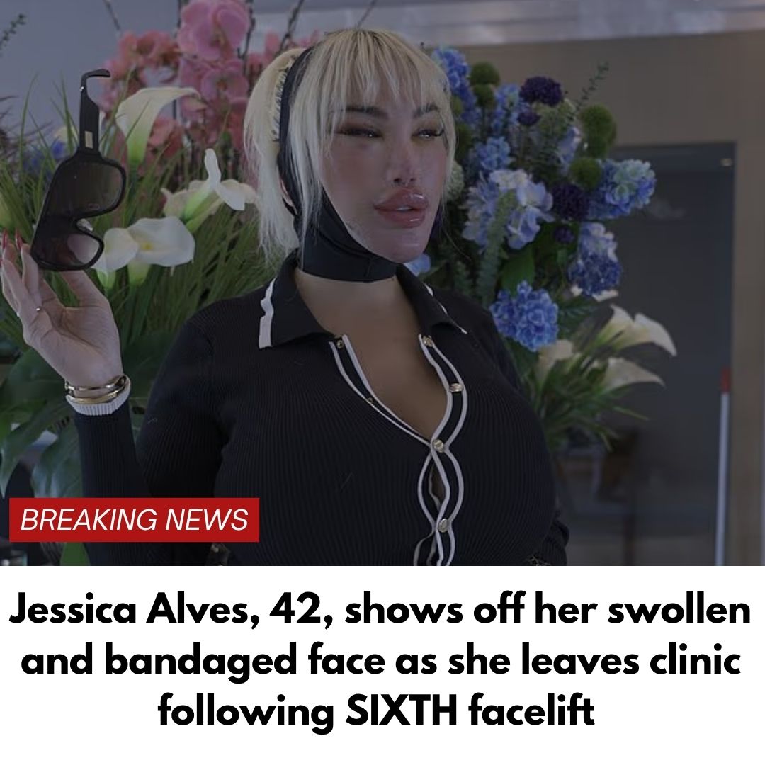 Jessica Alves, 42, shows off her swollen and bandaged face as she leaves clinic following SIXTH facelift
