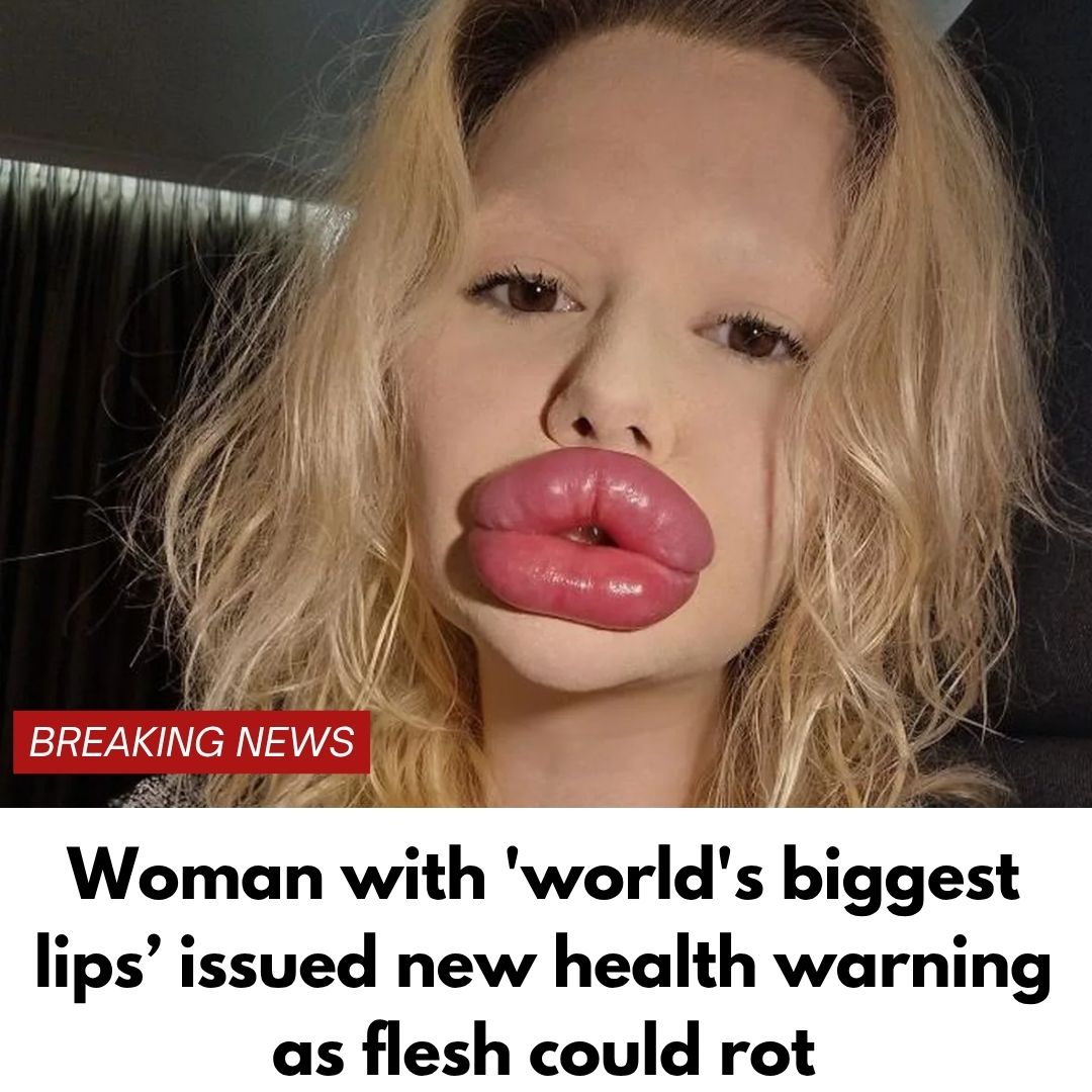 Woman with ‘world’s biggest lips’ issued new health warning as flesh could rot