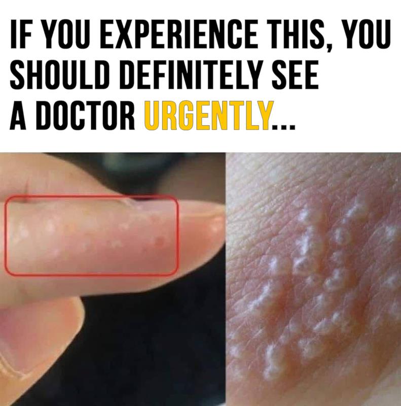 If you get these painful red bumps, you may have dyshidrotic eczema