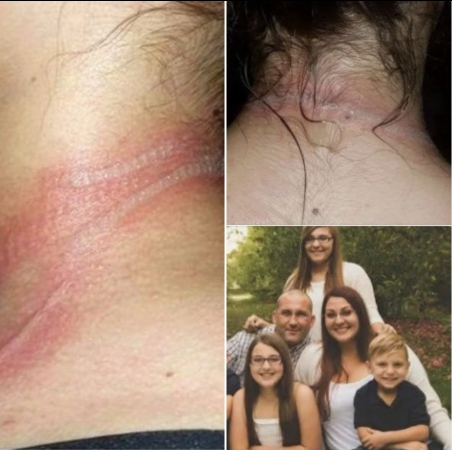 13-year-old girl left with horrific burns on her neck after using her cellphone while it was charging
