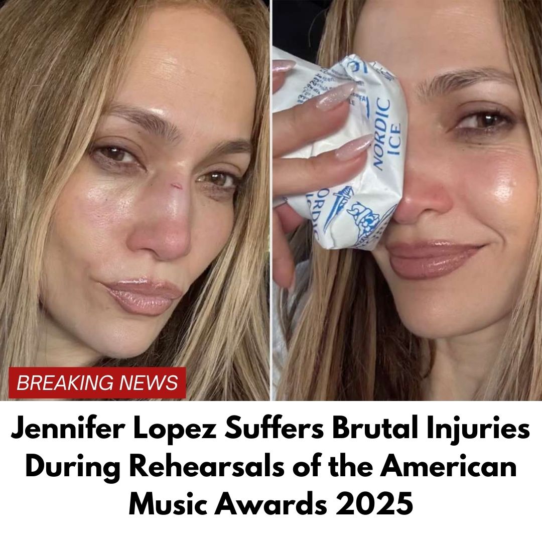 Jennifer Lopez Suffers Brutal Injuries During Rehearsals of the American Music Awards 2025