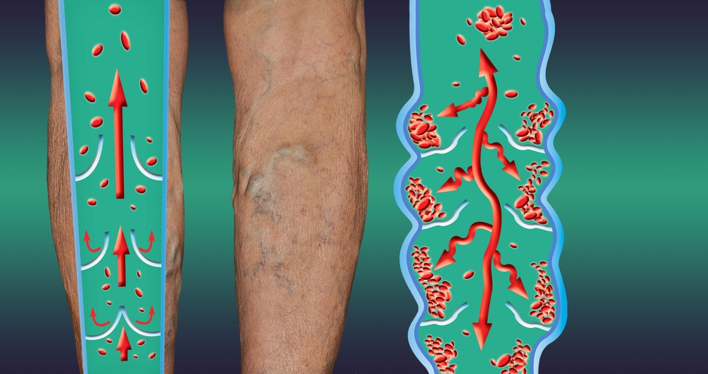 If you see someone with bulging veins, you must tell them these things