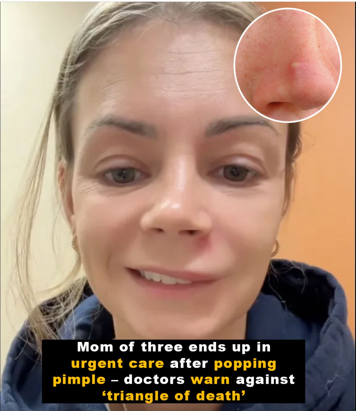 Doctors warn of popping pimple in ‘triangle of death’