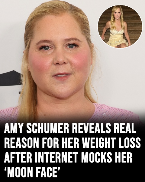 Amy Schumer reveals real reason for her weight loss after internet mocks her ‘moon face’