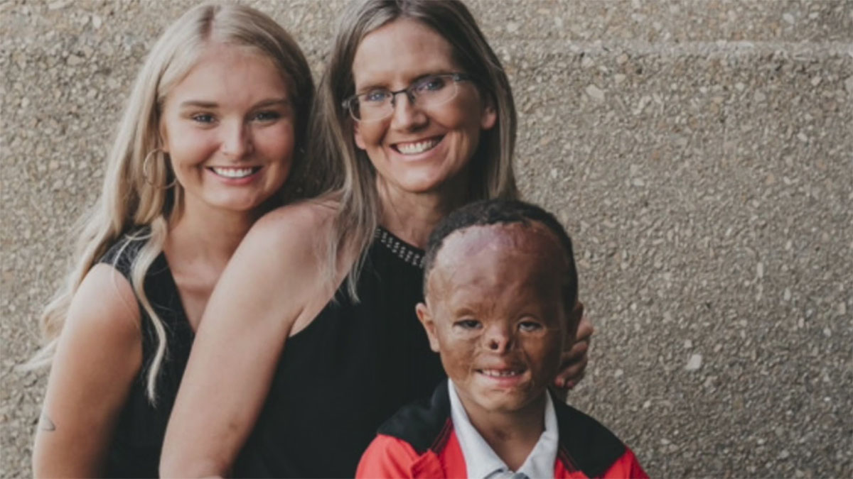 Foster baby is adopted 7 years after apartment fire left him with horrific burns