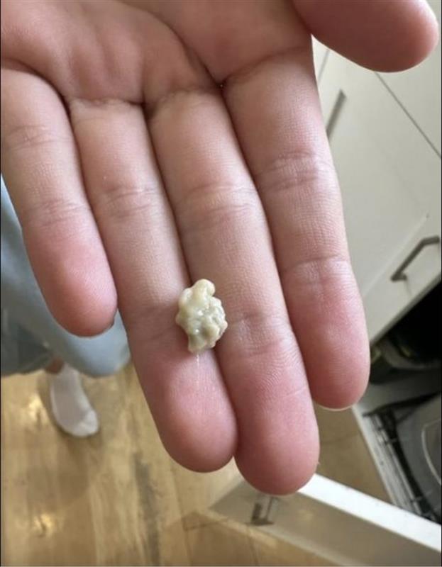 Here’s what you need to know about tonsil stones