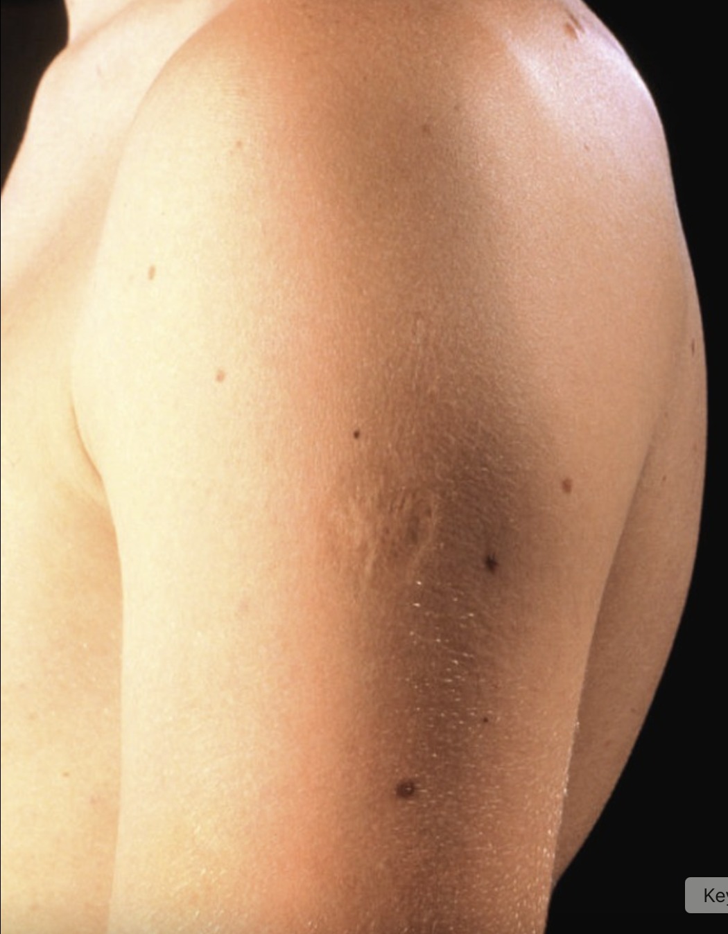 Smallpox vaccine scars: What they look like and why