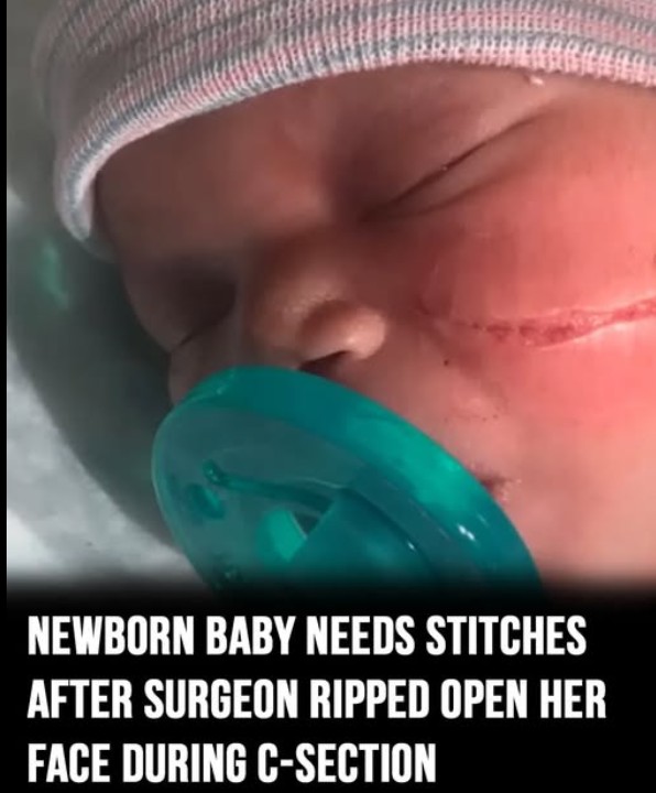 Surgeon Accidentally Tears Newborn’s Face During C-Section, Requiring 13 Stitches