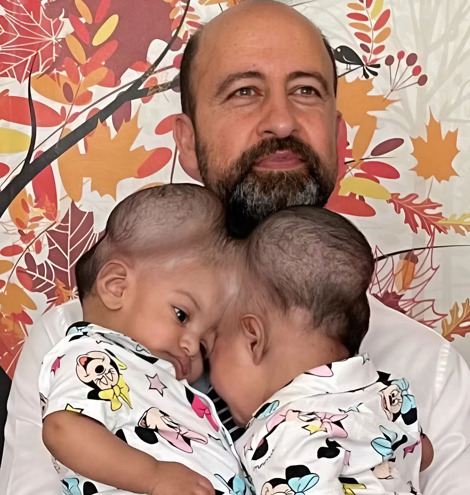 The sisters were born with one head for the two of them, but when they turned 3, doctors separated them: this is how they look today