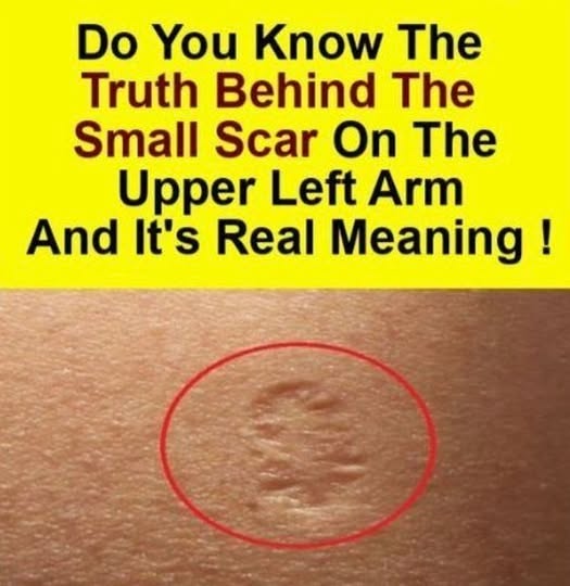 Smallpox vaccine scars: What they look like and why!