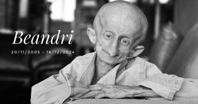 Beandri Booysen: Girl in South Africa with progeria dies!