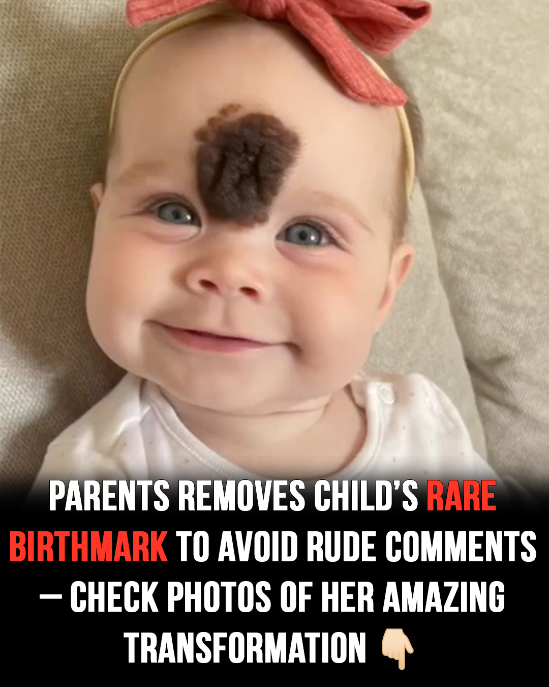 Cruel reactions force parents to remove baby’s rare birthmark!