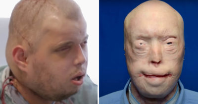Firefighter suffers third-degree burns – this is him 11 years later!