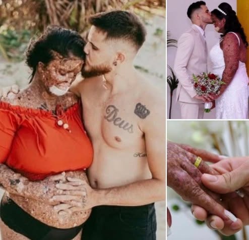 Woman with rare skin condition overcomes negativity and finds true love!