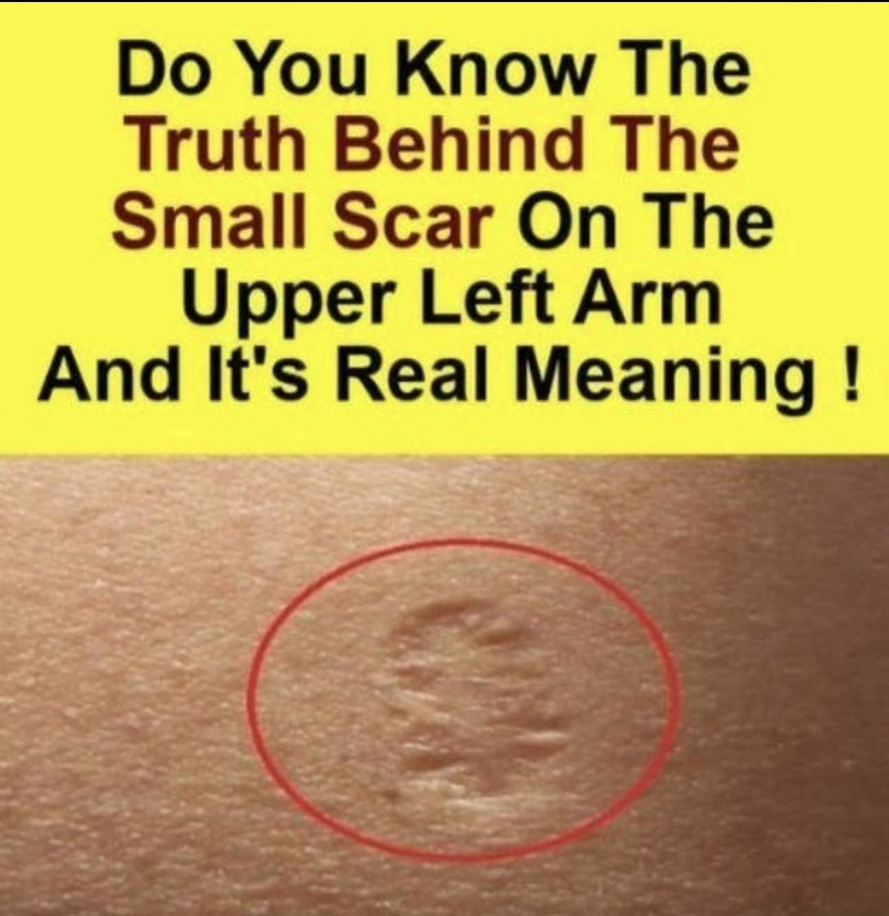 Smallpox vaccine scars: What they look like and why!