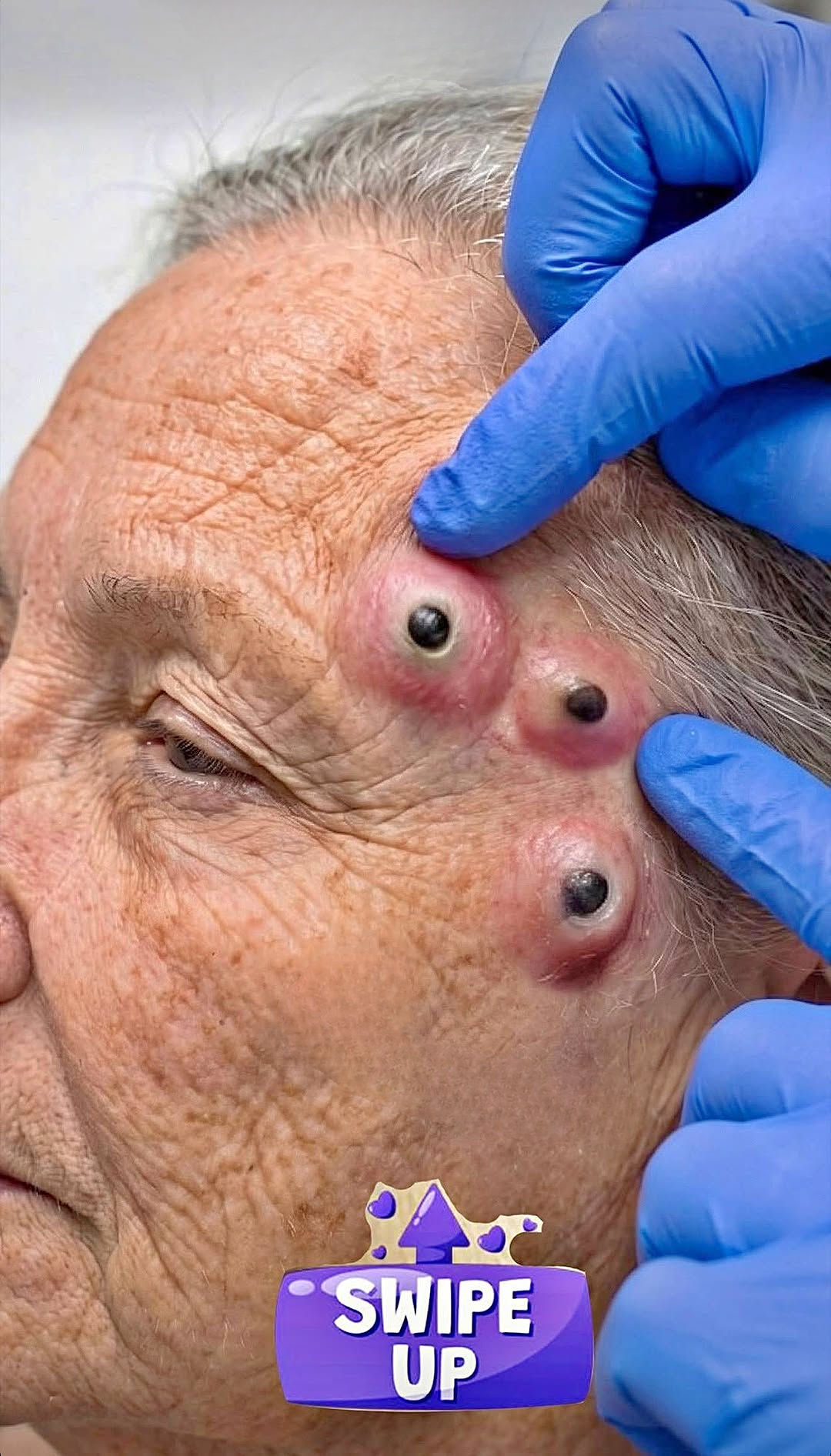 Why Nose Acne Is So Common — and What It Really Means