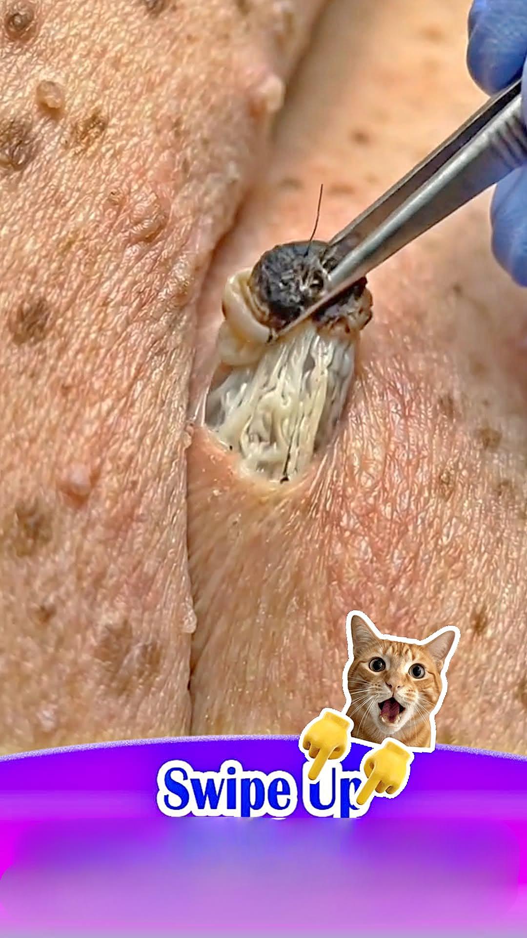 Why Popping Blackheads Can Damage Your Skin